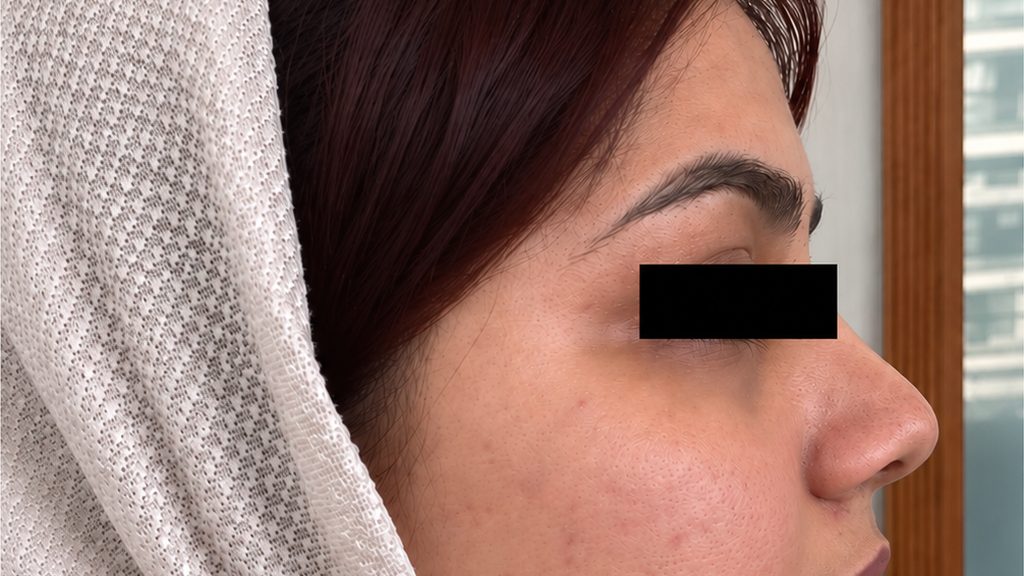 Profile view of the same patient's cheek after acne treatment at Absolute Cosmetic Clinic