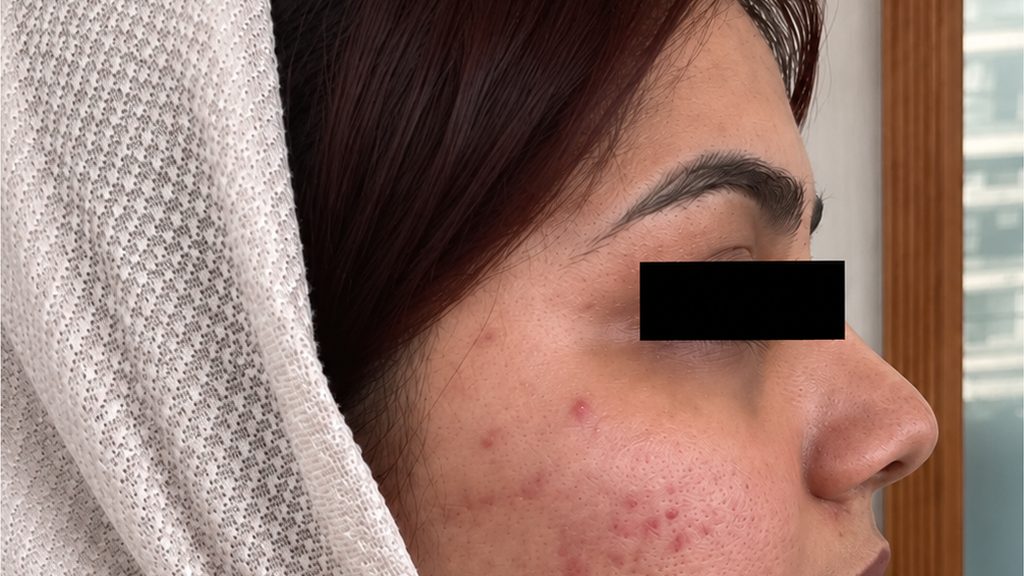 Profile view of a patient's cheek with active acne, before treatment