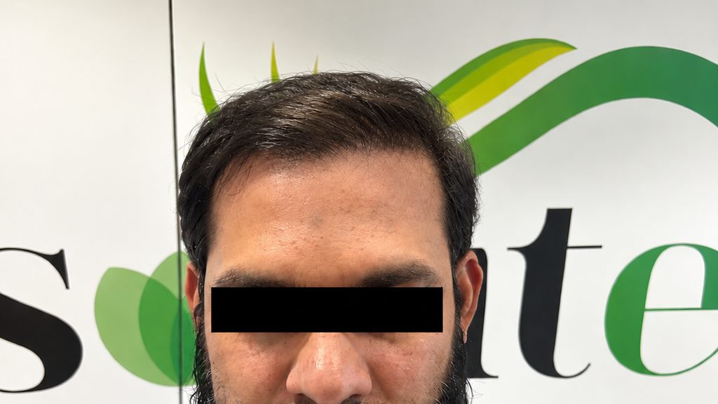 Front view of the same patient with a restored hairline after a hair transplant at Absolute Cosmetic Clinic