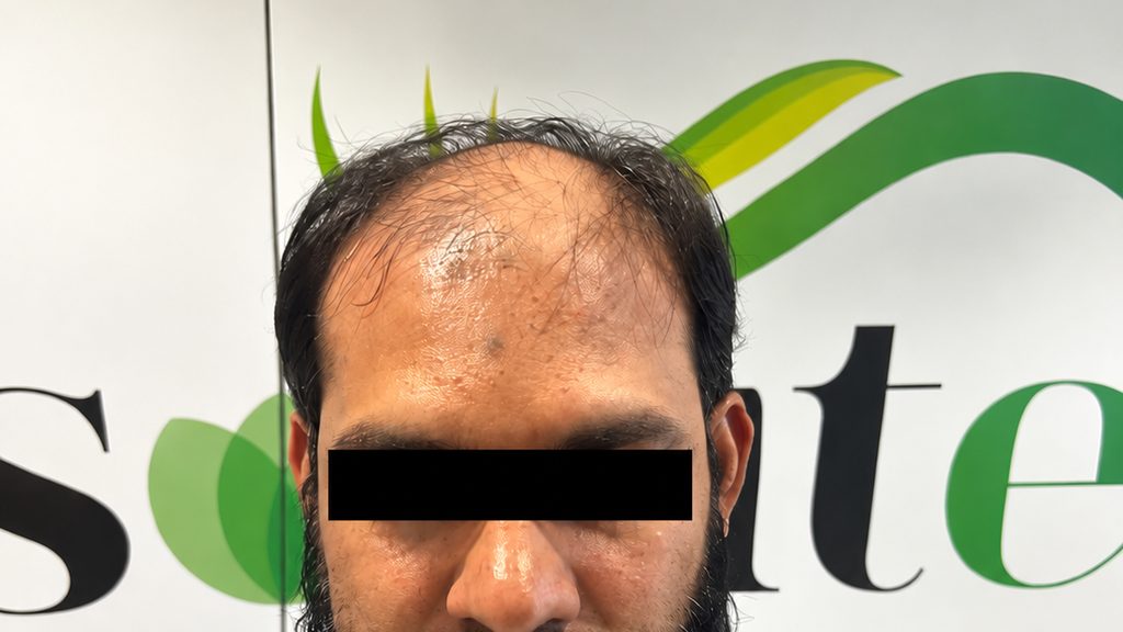 Front view of a patient with a receding hairline and thinning at the temples, before treatment