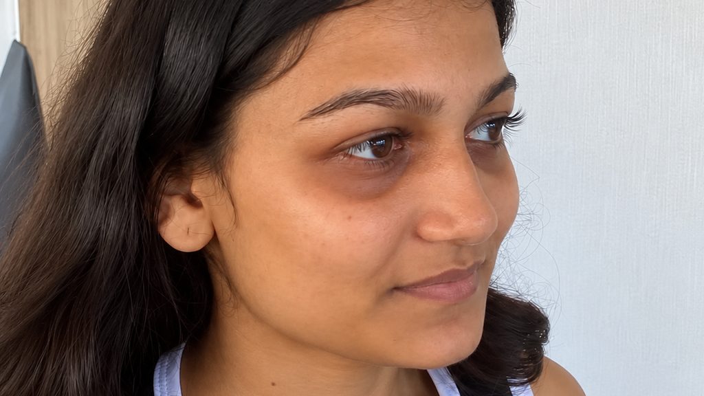 Three-quarter view of a patient's face and jawline before HIFU treatment