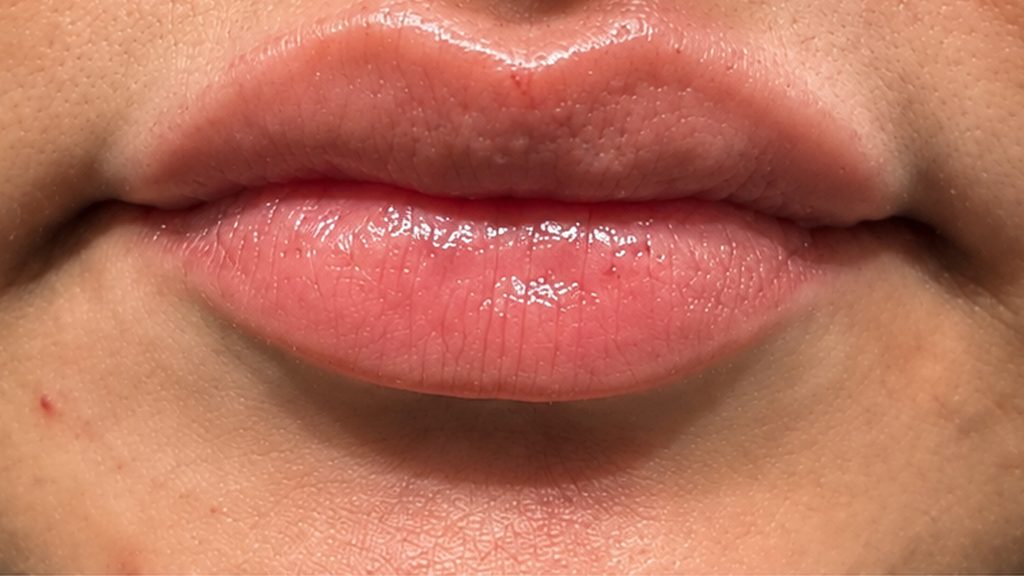 Close-up of the same patient's lips after lip filler treatment at Absolute Cosmetic Clinic