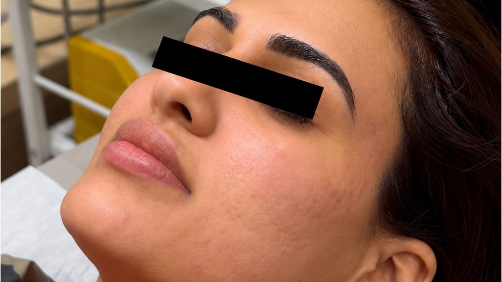 Close-up of the same patient's cheek after MNRF treatment at Absolute Cosmetic Clinic