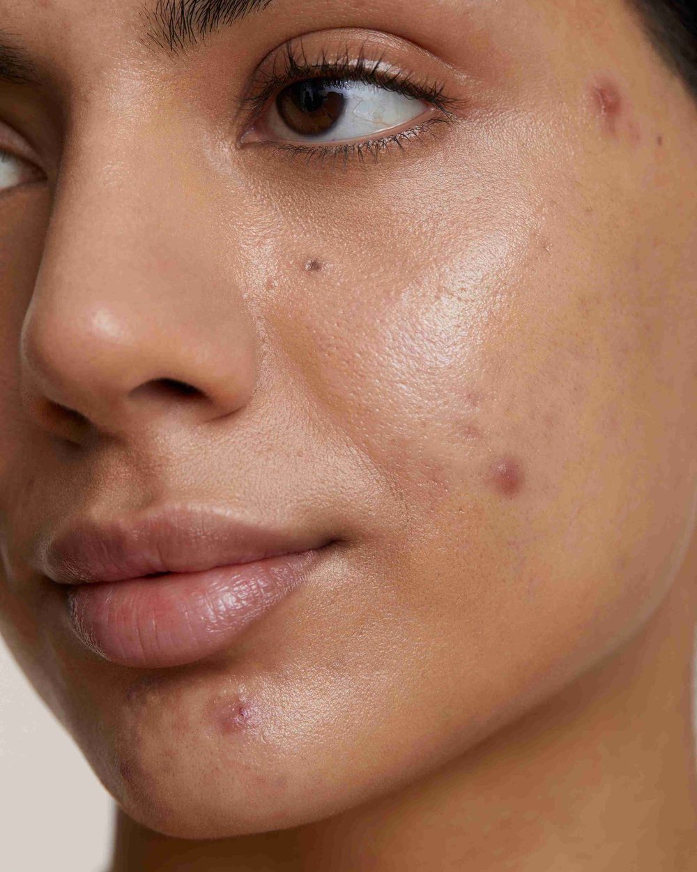 Close-up of a patient's face showing active acne across the cheek and jawline