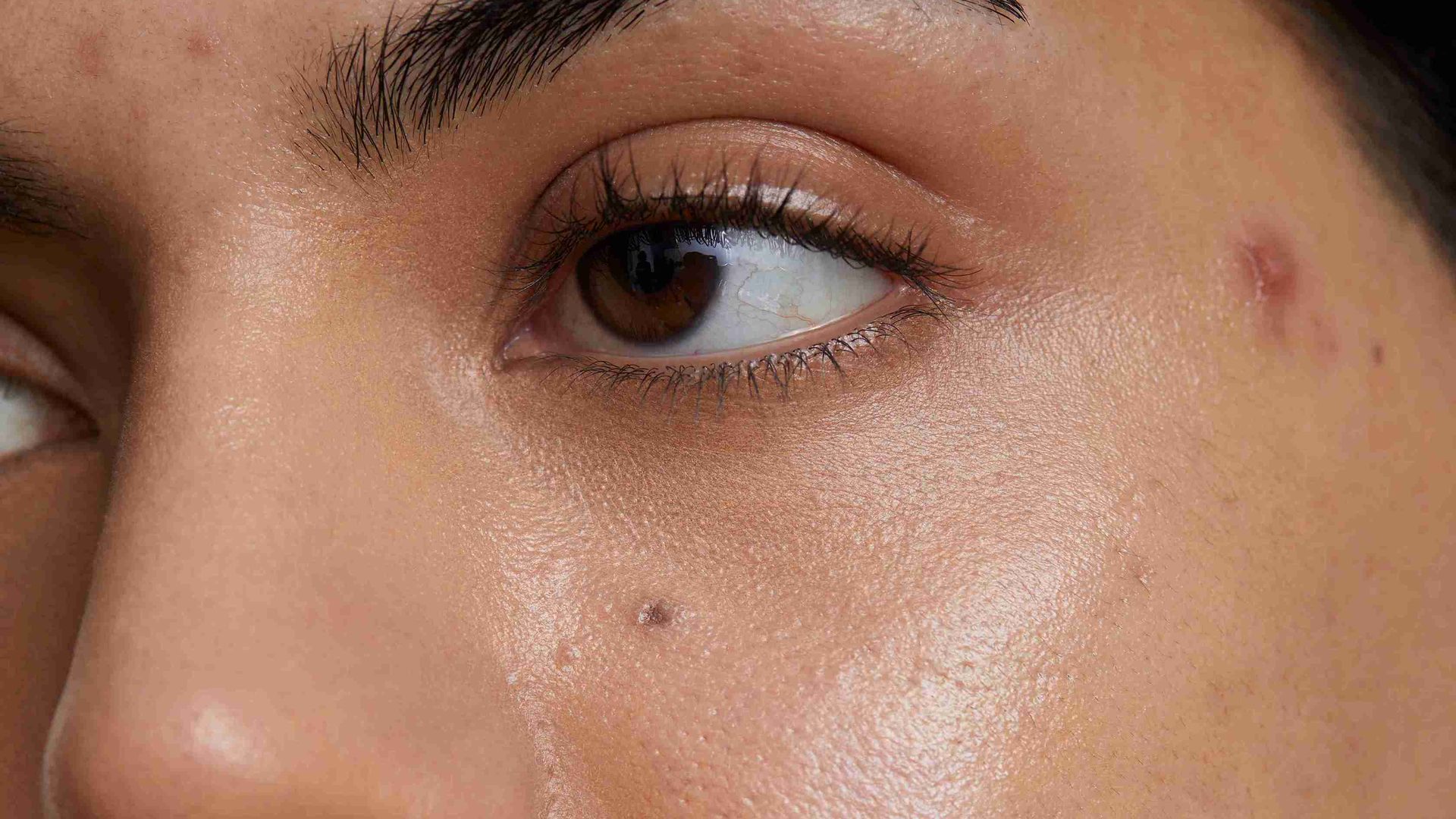Close-up of a patient's cheek showing active acne before treatment at Absolute Cosmetic Clinic, Andheri West